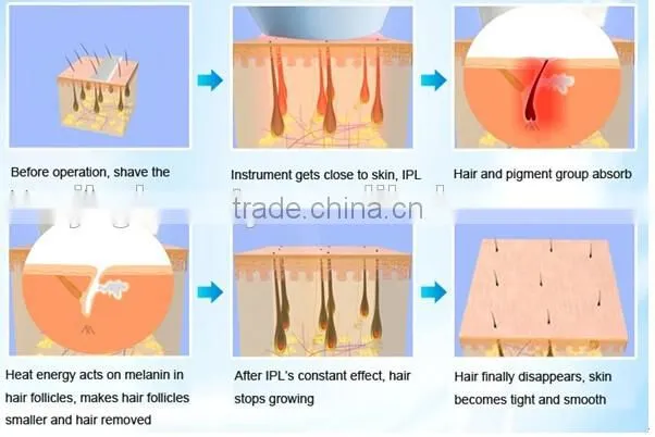 JBG-MINI808 diode laser hair removal machine/808nm diode laser hair removal machine price