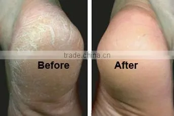 Multifunctional Electric Callus Remover As Seen On TV 2013 New Products