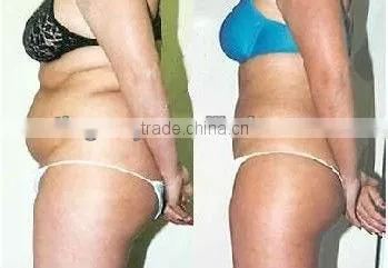40K cavitation and 1 mhz ultrasound slimming machine TM-660A