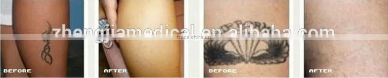 2014-Newest Portable laser tattoo removal machine,Nd-yag skin whitening machine