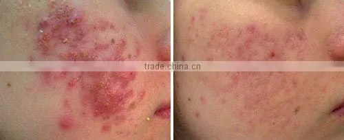Multifunction facial beauty machine for skin rejuvenation skin care product