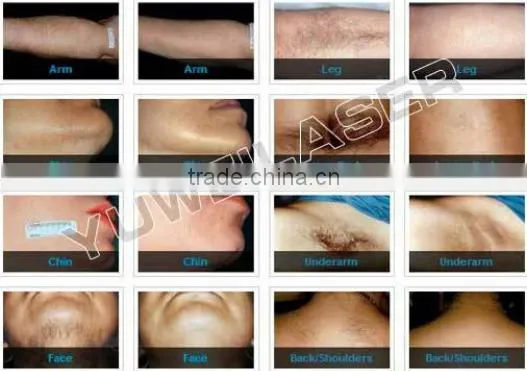 New products bikini line hair removal machine 808nm diode laser hair removal
