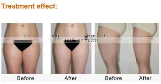 Diode laser weight loss machine NL-RUV900 Cellulite Dissolving And Body Slimming equipment
