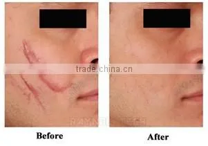 Professional 40W RF Tube Micro Fractional CO2 Laser Medical CE Certification
