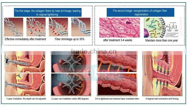 Easy to use hifu vaginal tighten for woman