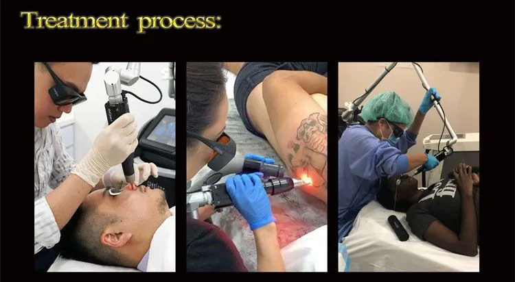 Portable Pico Laser Pigmentation Tattoo Removal Laser 755nm Pigment Removal Beauty Machine