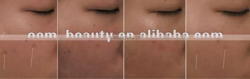 Skin micro-needling /Collagen Induction Therapy Derma Roller Manufacturer