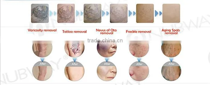 Medical laser tattoo removal equipment/nd yag laser tattoo removal equipment/tattoo removal equipment supplier