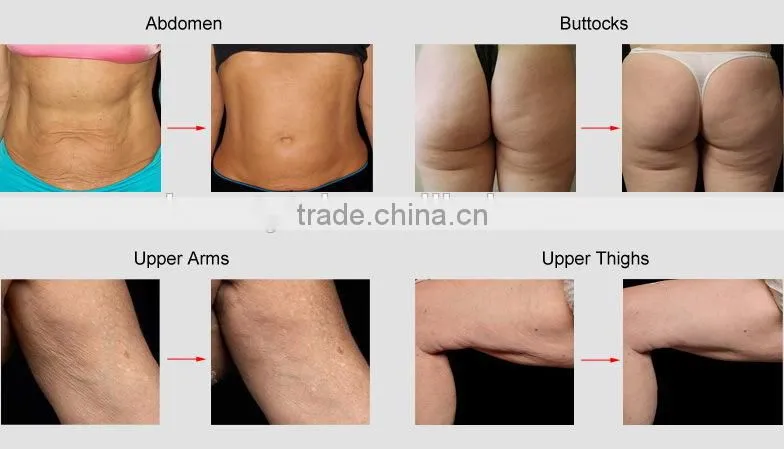 Home Use Portable RF Vacuum Ultrasonic Cavitation Liposuction Beauty Equipment
