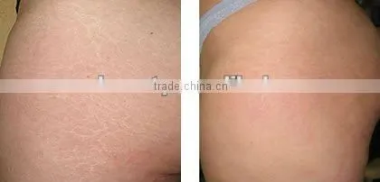 Treatment for cystic acne titanium vibration derma roller L007