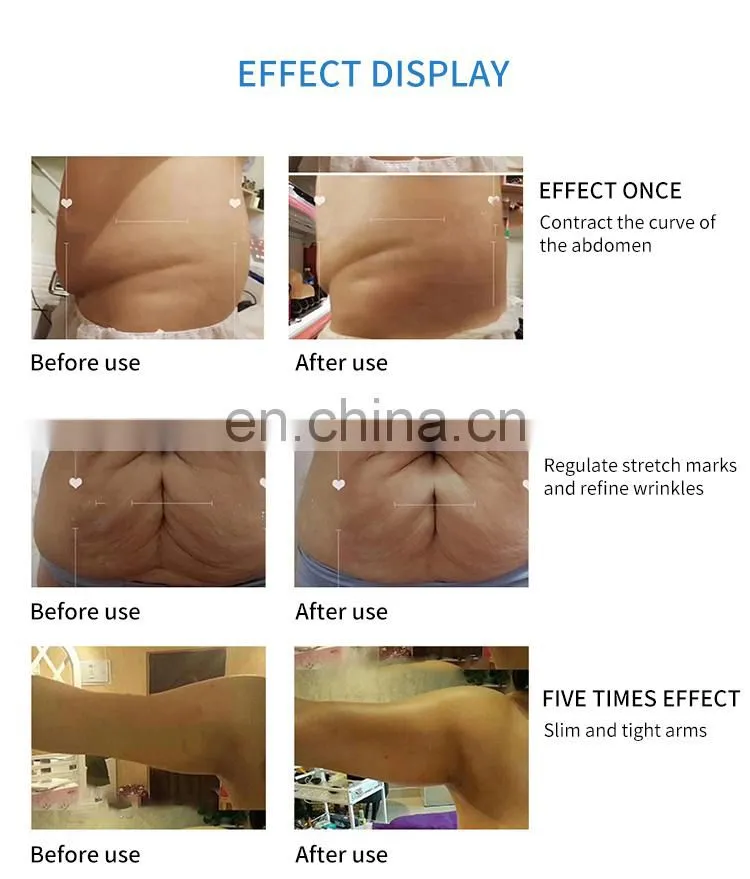 RF Vacuum Microwave Fat Crushing Body Shaping Instrument Cellulite Reduction Cupping Therapy Weight Loss Body Slimming Machine