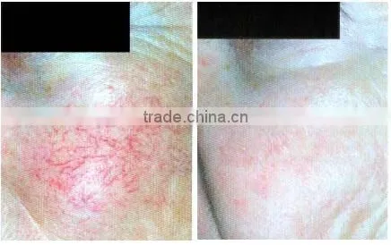 2014 New design RBS high frequency vascular removal machine