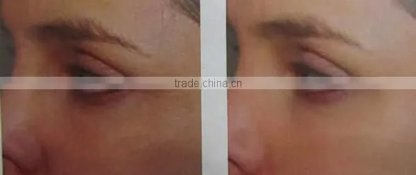 # portable fractional co2 laser equipment for acne scar removal