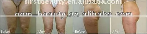 Fat reduction!!no pain and instant ultrasound liposuction equipment for men and women