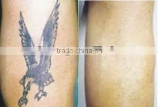 Temporary removal Tattoo products-Q Switched Nd 1064nm yag Laser D001