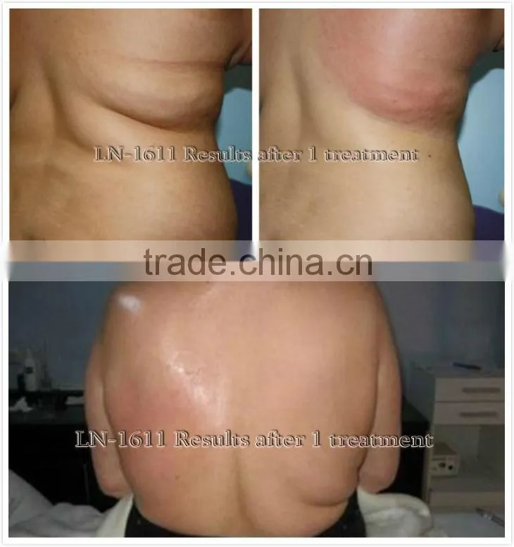 Best tripolar rf cavitation slimming machine, slimming machine ,slimming equipment