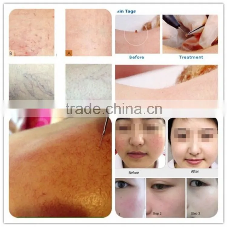 portable laser spider vein and vascular removal machine