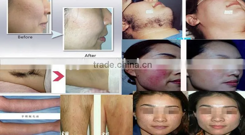 New hone use venus laser ipl shr laser hair removal