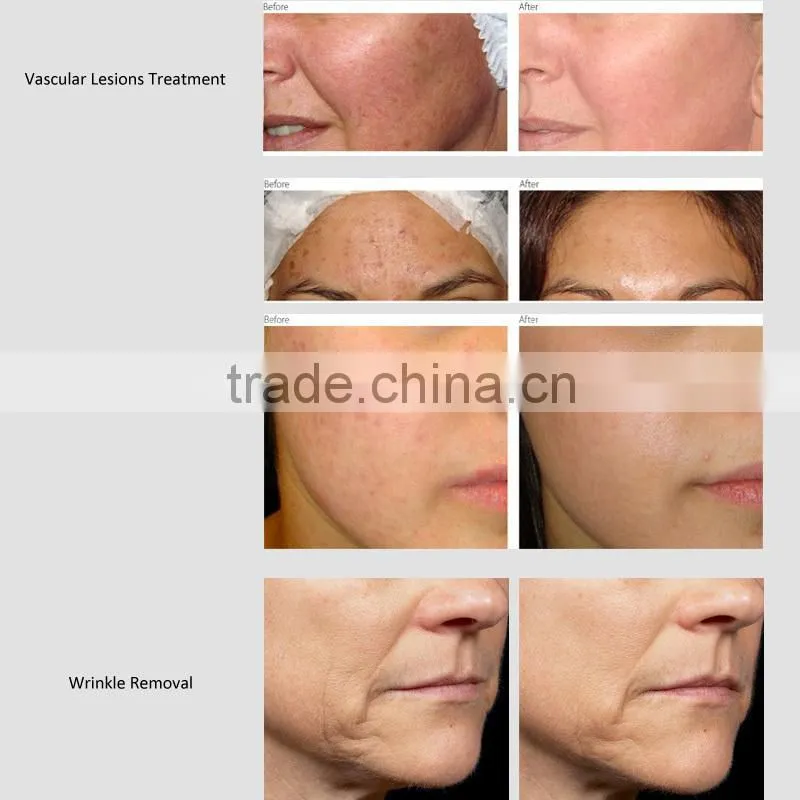 IPL beauty machine,Multifunctional and perfect hair removal equipment with 100000shots life span,IPL portable