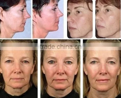 China Derma Roller of different needles size for Skin and aesthetic treatment.