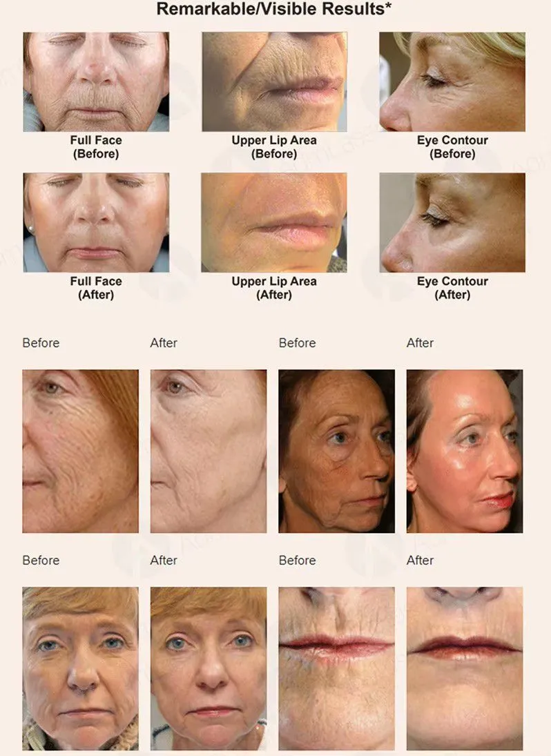 Facial Skin Whitening Vaginal Tightening 10600nm RF Co2 Laser Carbon Laser for Skin Fractional Co2 Laser