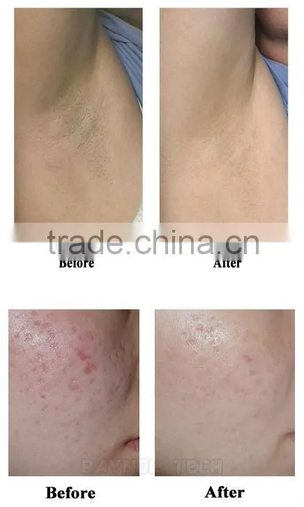 690-950nm Import Lamp 3000W Laser IPL SHR Permanent Hair Removal Machine