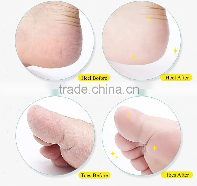 New Hot Callus Remover