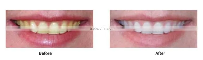 Professional Blue Light Teeth Whitening Light, Dental Teeth Whitening Machine