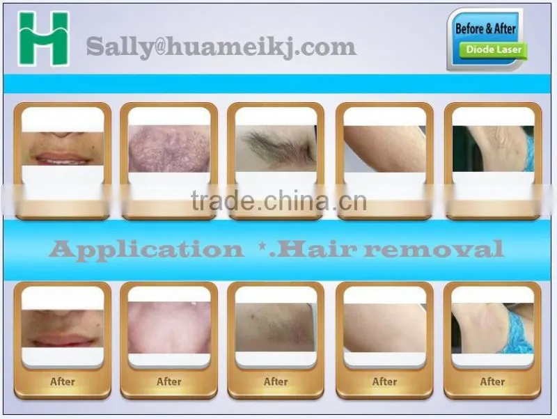 808 nm diode laser machine for hair removal