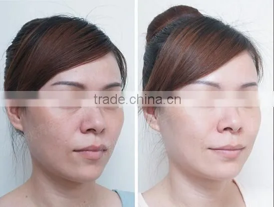 CE approval led pdt acne treatment beauty machine