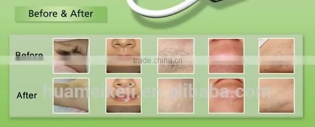 Efficient pain free 808nm diode laser