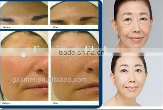 Top rated good pump 4 in 1 oxygen and water jet peel facial skin care machine for facial cleaning and rejuvenation