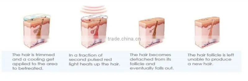High quality Professional 808 diode laser hair removal equipment