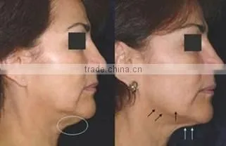 2012 RF facial lifting and firming machine