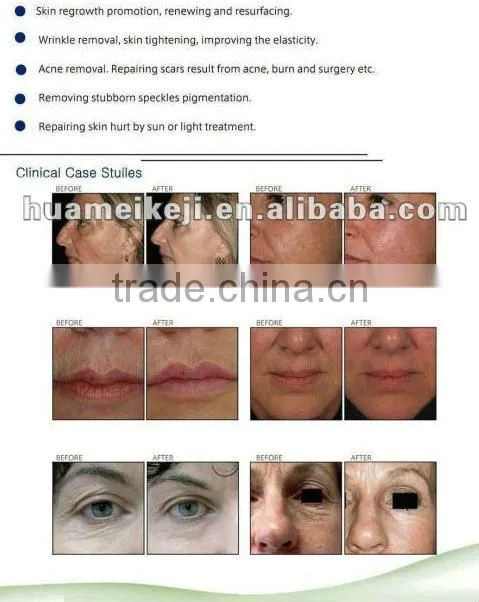 808nm Diode Laser permanent Hair Removal Machine