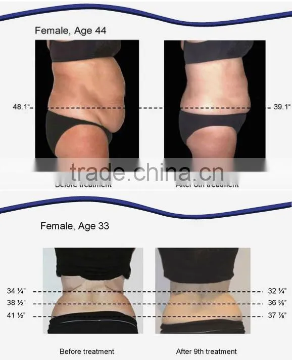 Popuar laser RF slimming machine/ vacuum machine/ cavitation machine for sale