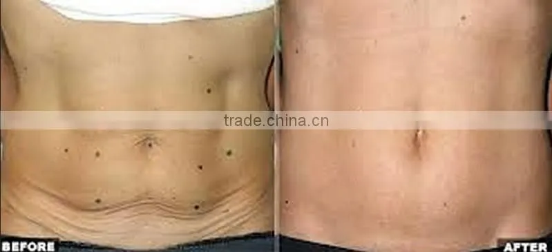 Hot Fractional & Micro needle RF machine for face lifting & skin rejuvenation