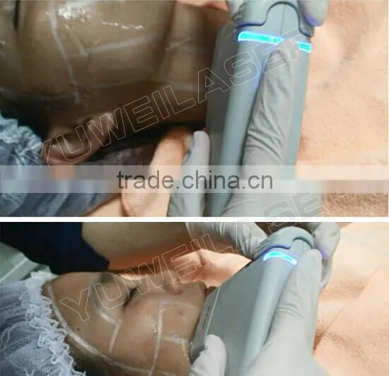 hifu focused ultrasound transducer skin lifting