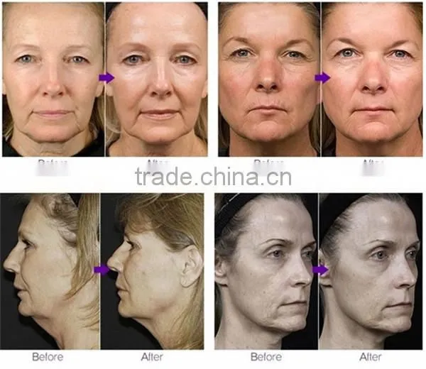 Factory price!!!rf fractional microneedle for Whiten Skin & Restore Skin Elasticity