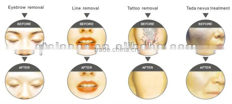 nd yag laser pulsed dye laser for tattoo