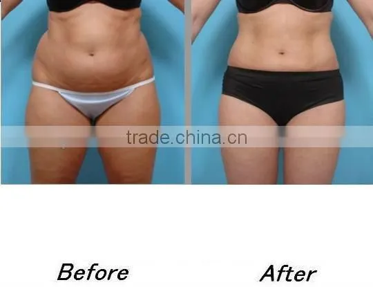 Cavitation Professional Beauty Fractional RF Facial Beauty & Body Shaping - DOUBLO