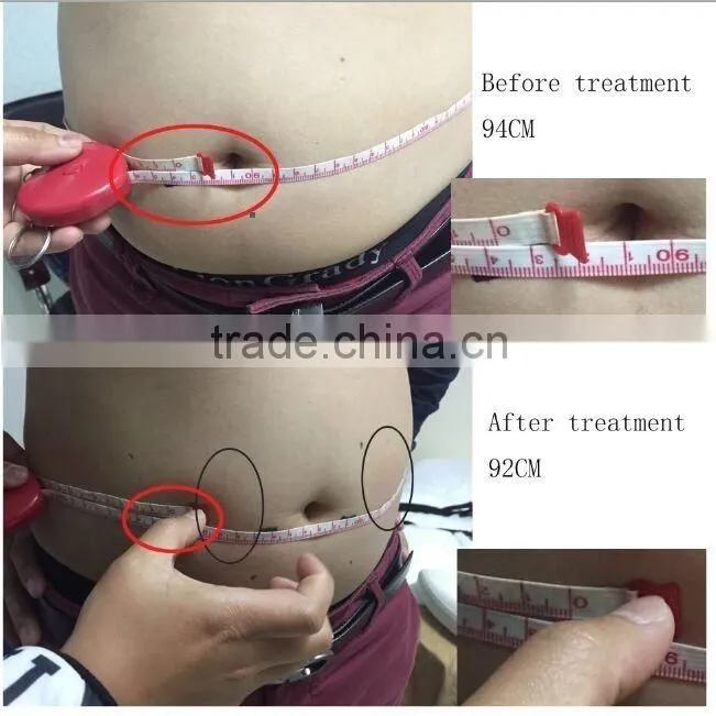 AYJ-S12B CE portable hifu slimming machine/liposonix slimming equipment