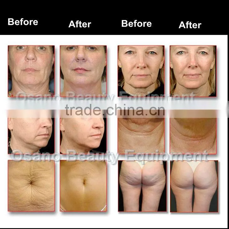 Distributor wantted 5 IN 1 Lipo ultrasound rf cavitation device
