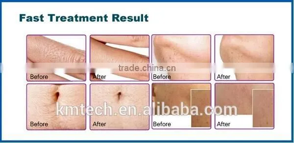 Professional permanent Hair Removal equipment 808nm diode laser Hair Removal machine