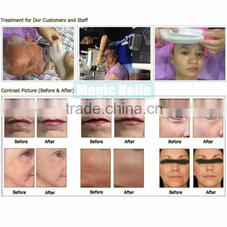 4 tips HIFU Machine Removal Double Chins Professional Clinic HIFU Machine with Teaching Video
