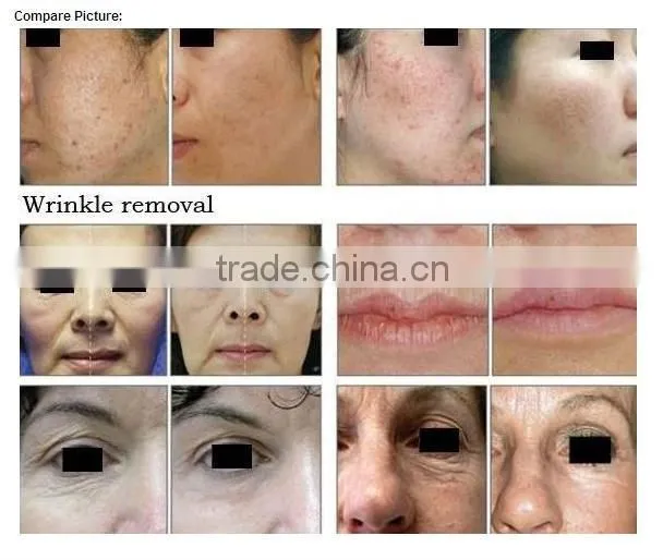 30W OEM 10600nm glass tube RF CO2 laser for skin treatment