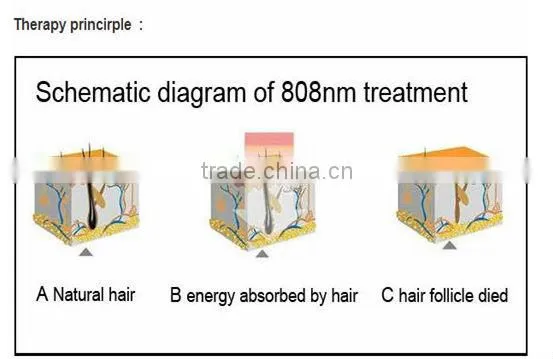 permanent epilation 810nm diode laser for black skin and skin resurfacing