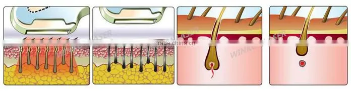 portable ipl / xenon lamps for ipl / home ipl
