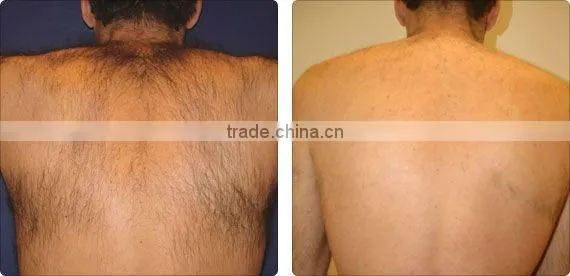 2016 clinic wanted 808nm Lightsheer laser depilation/hair removal laser diode/diode laser beauty machine