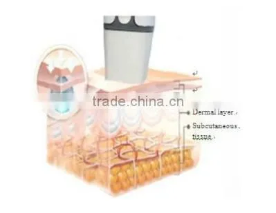 Beauty supply skin tightening thermagic rf machine